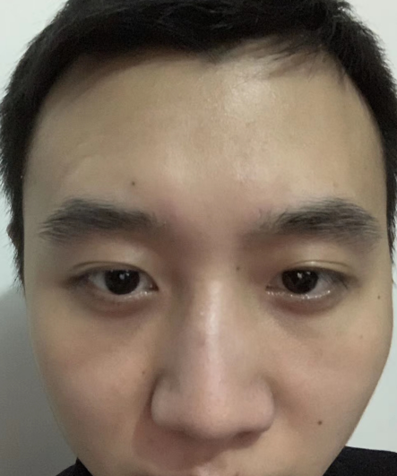去眼袋手术