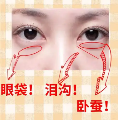 去眼袋手术