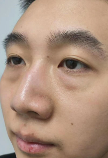 去眼袋手术