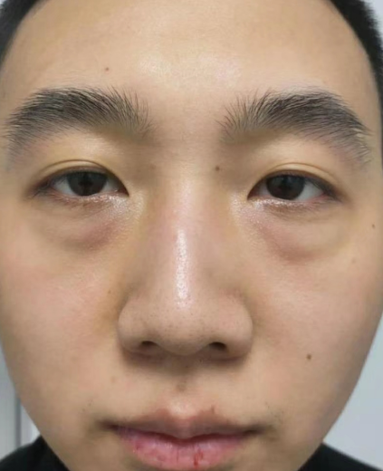 去眼袋手术