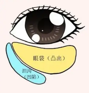 去眼袋手术