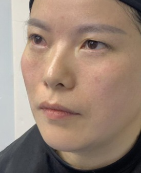 去眼袋手术