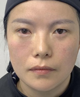 去眼袋手术