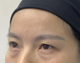 去眼袋手术