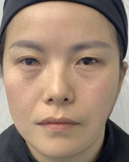 去眼袋手术