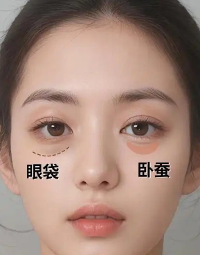 去眼袋手术