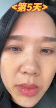 去眼袋手术