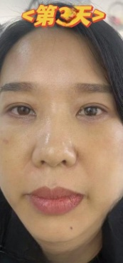 去眼袋手术