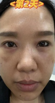 去眼袋手术