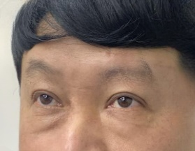 去眼袋手术