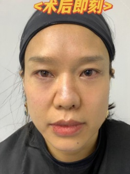 去眼袋手术