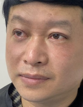 去眼袋手术