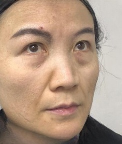 去眼袋手术