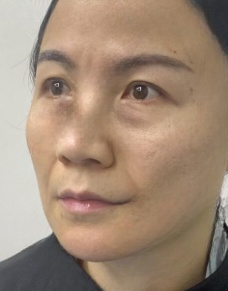 去眼袋手术