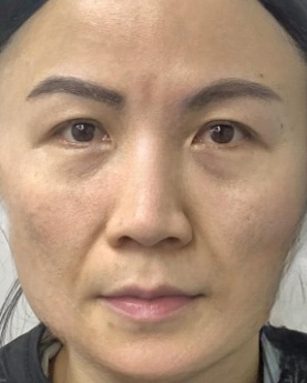 去眼袋手术
