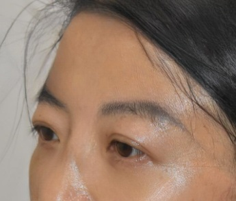 去眼袋手术