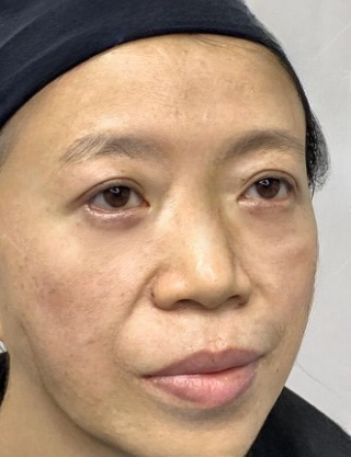 去眼袋手术