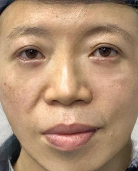 去眼袋手术