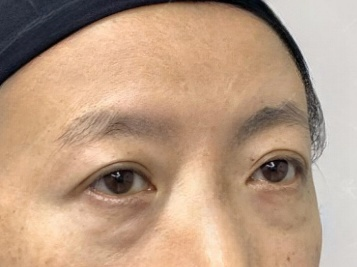 去眼袋手术