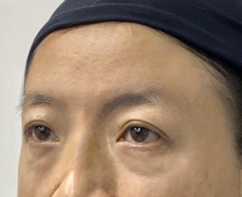 去眼袋手术