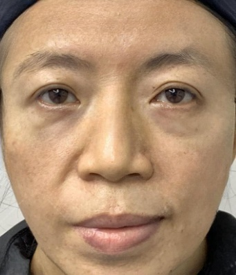 去眼袋手术