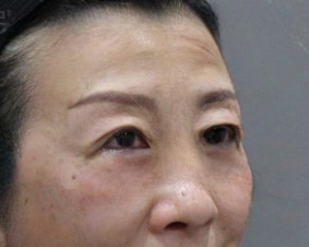 去眼袋手术