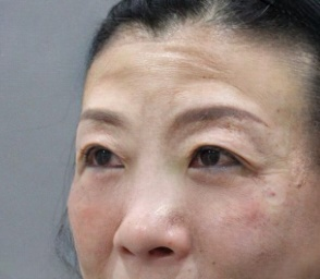去眼袋手术