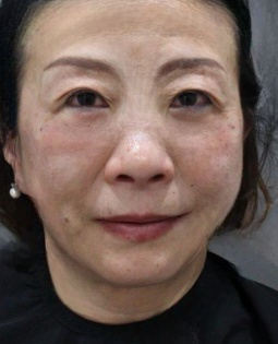 去眼袋手术