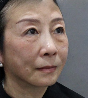 去眼袋手术