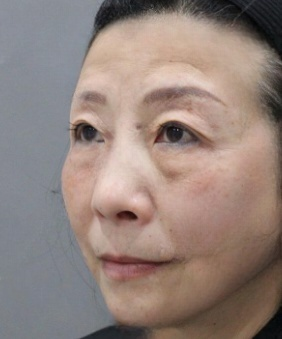去眼袋手术