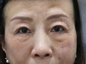 去眼袋手术