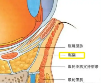 去眼袋手术