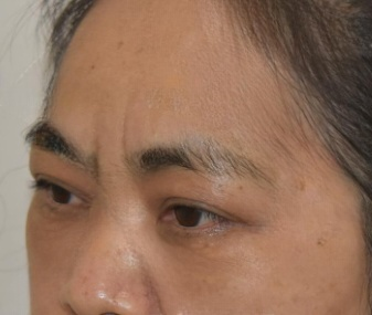 去眼袋手术