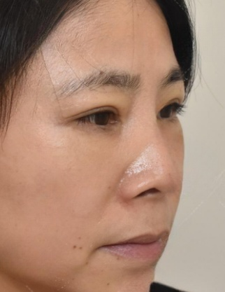 去眼袋手术