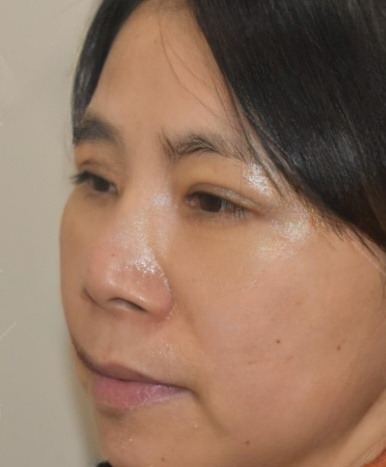 去眼袋手术