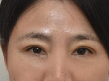 去眼袋手术