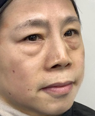 去眼袋手术