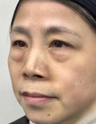 去眼袋手术