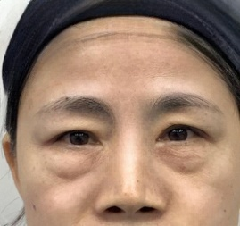 去眼袋手术