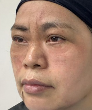 去眼袋手术