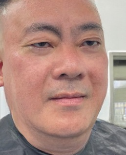 去眼袋手术