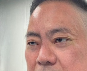 去眼袋手术