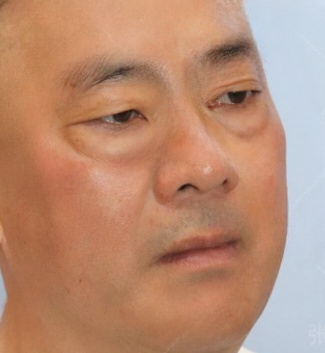 去眼袋手术