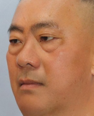 去眼袋手术