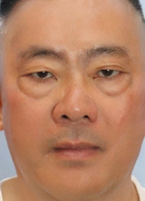 去眼袋手术