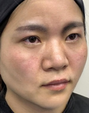 去眼袋手术