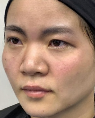 去眼袋手术