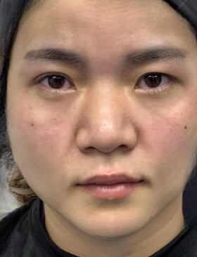 去眼袋手术