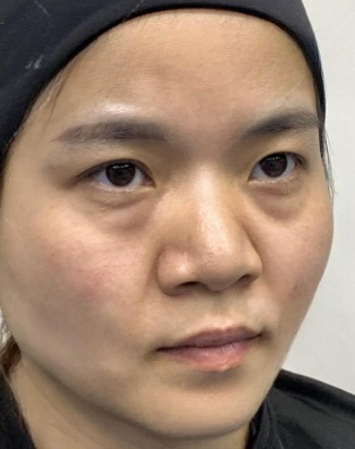 去眼袋手术