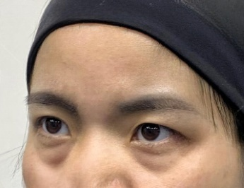 去眼袋手术